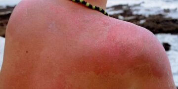 новость 10-06-2025 Аллергия на солнце в Турции: правда или страшилка для туристов?