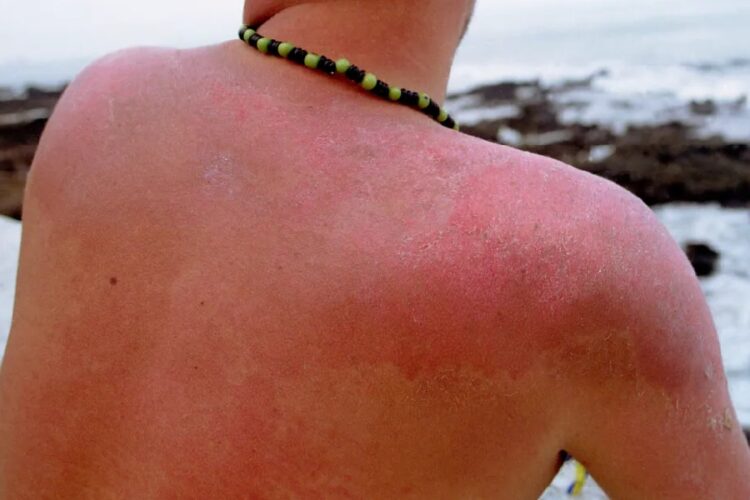 новость 10-06-2025 Аллергия на солнце в Турции: правда или страшилка для туристов?